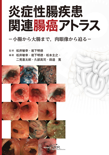 炎症性腸疾患関連腸癌アトラス―小腸から大腸まで、肉眼像から迫る 